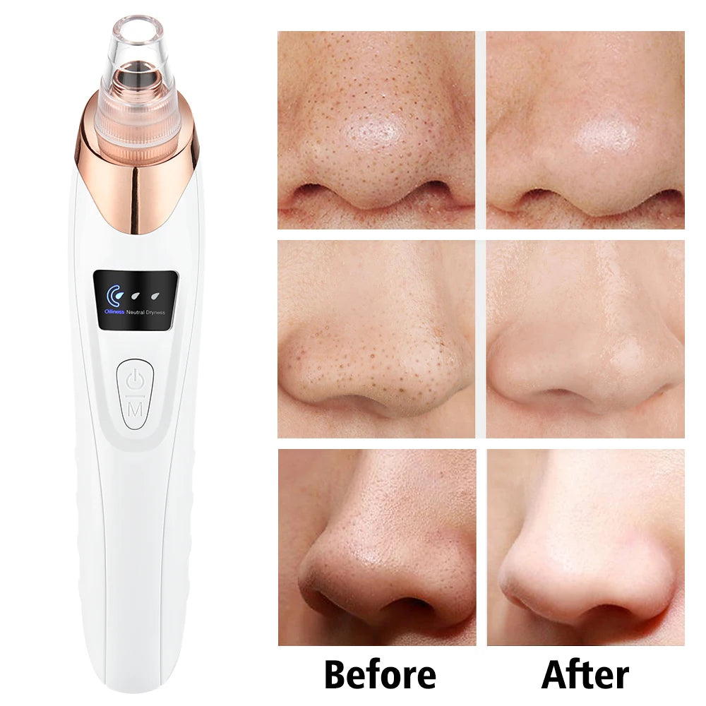 USB Rechargeable Electric Blackhead Remover – Vacuum Suction Pore Cleaner for Acne, Pimples, and Comedones