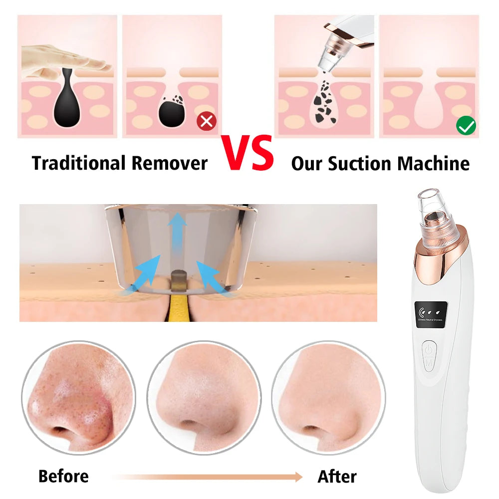 USB Rechargeable Electric Blackhead Remover – Vacuum Suction Pore Cleaner for Acne, Pimples, and Comedones